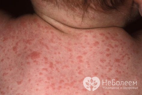 Цитомегаловирус – симптомы, лечение, классификация