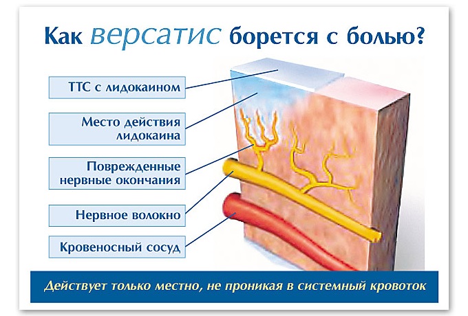 Применение обезболивающего пластыря версатис с лидокаином