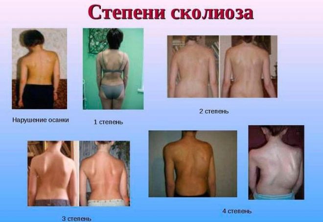 Что такое сколиоз у детей и как его вылечить?