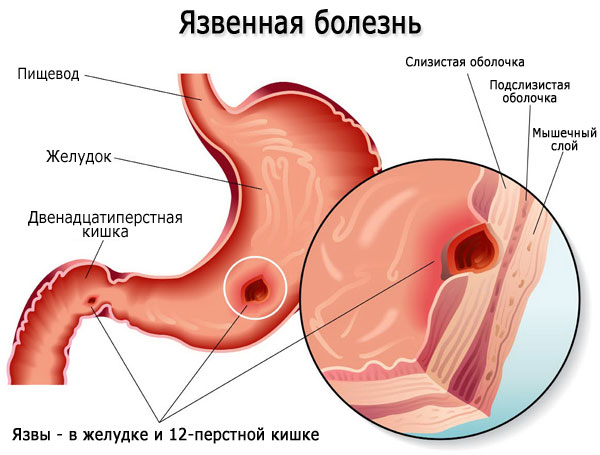 Язва двенадцатиперстной кишки. причины, симптомы, современная диагностика и эффективное лечение