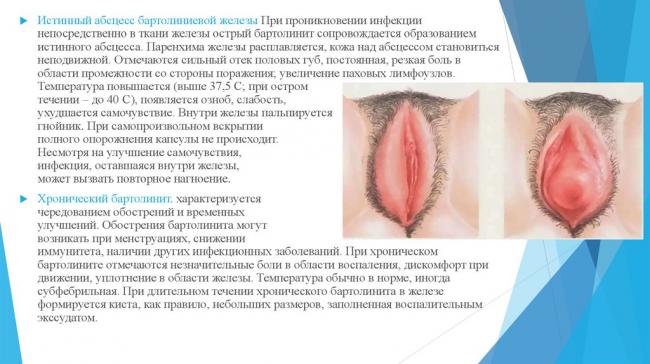 Абсцесс бартолиновой железы: причины, симптомы, лечение
