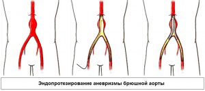 Аневризма брюшной аорты. причины, симптомы, признаки, диагностика и лечение патологии