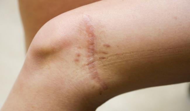Виды рубцов и шрамов на лице и теле