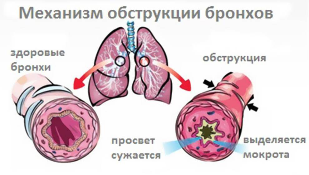 Лечение препаратами обострения хронического бронхита
