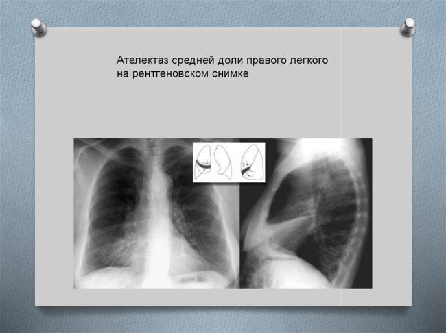 Ателектаз — что это такое? виды, симптомы и лечение, прогноз