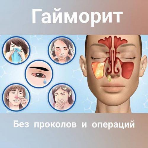Как правильно лечить синусит в домашних условиях — народные средства, аптечные препараты