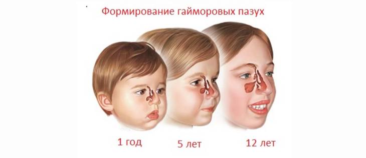 Чем лечить гайморит у взрослых?
