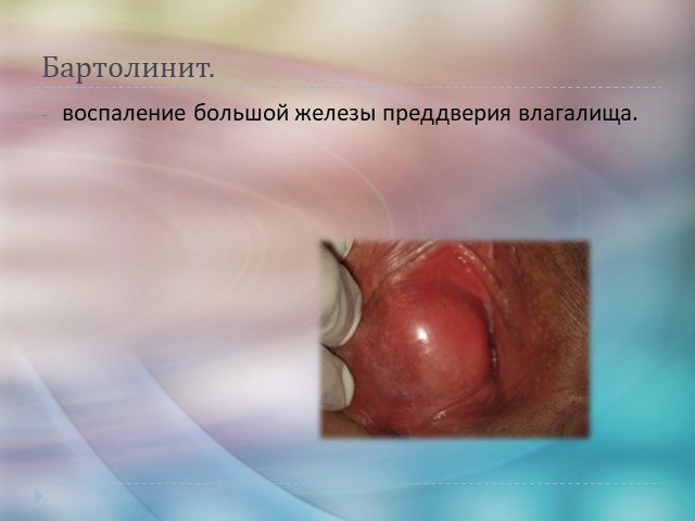 Бартолинит – деликатная проблема и ее лечение