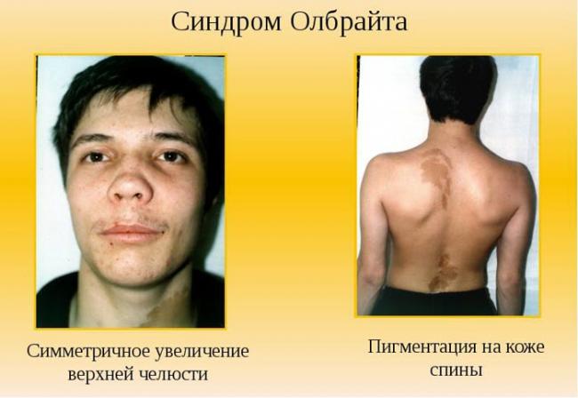 Псевдогипопаратиреоз (наследственная остеодистрофия олбрайта): сложности дифференциально-диагностического поиска. клиническое наблюдение