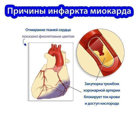 Признаки грядущего инфаркта можно узнать по лицу