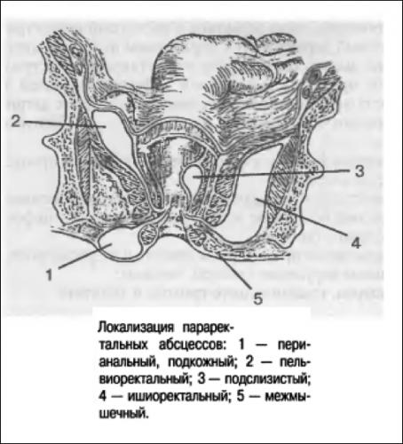 Абсцессы прямой кишки