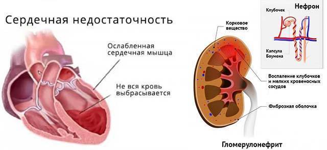 Симптомы отека горла и его лечение