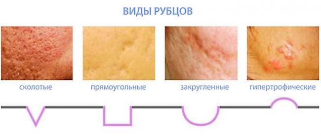 Рубцы на коже: причины, симптомы, диагностика и лечение
