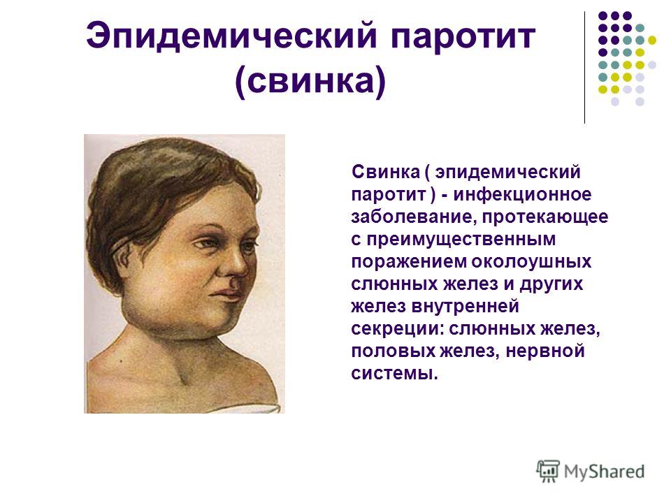 Паротит у детей
