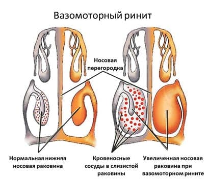 Вазомоторный ринит: народные средства и дыхательные упражнения