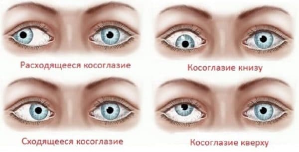 Косоглазие у новорожденных: 6 факторов косоглазия у младенцев, истинное косоглазие