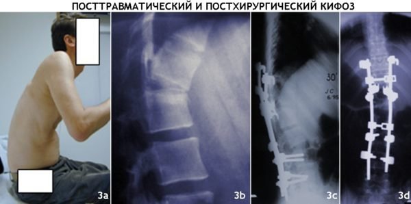 Что такое сколиоз у детей и как его вылечить?