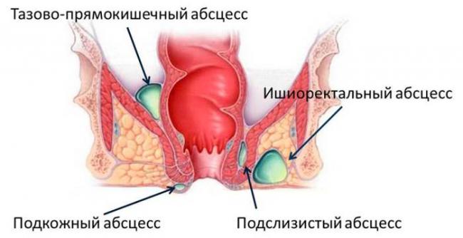 Парапроктит - симптомы, лечение, операция