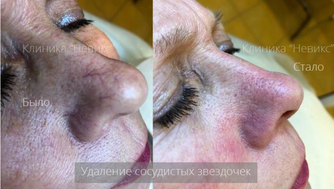 Как убрать сосудистые звёздочки на носу, ногах, подбородке...