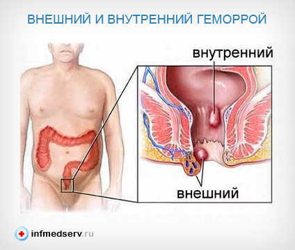 Аллергический зуд в заднем проходе. зуд в заднем проходе у женщин