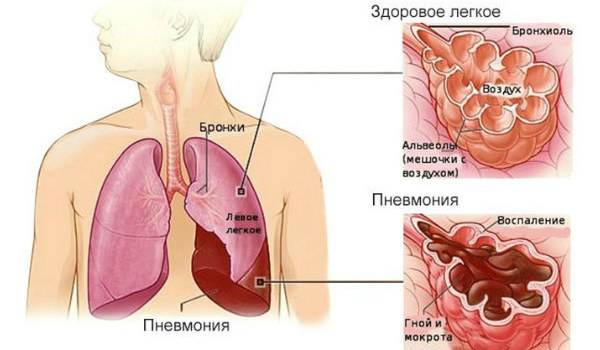 Инкубационный период пневмонии: сколько дней, заразно ли воспаление легких