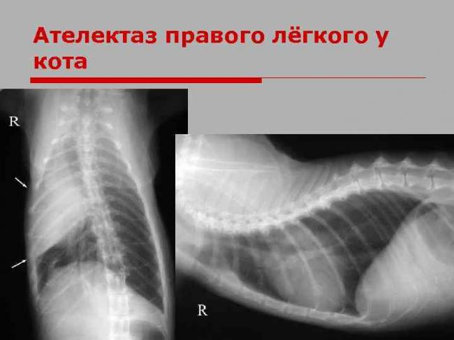 Ателектаз легких у новорожденных: причины заболевания, основные симптомы, лечение и профилактика