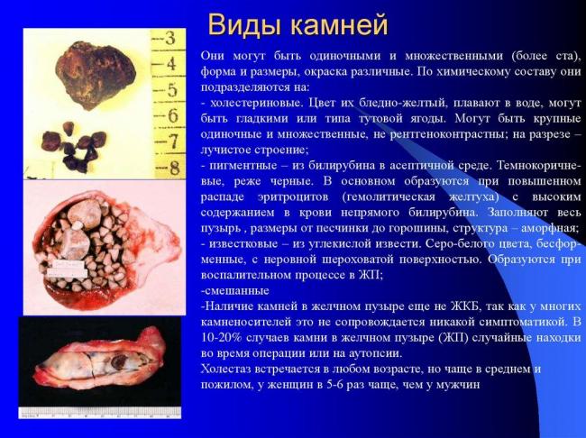 Желчнокаменная болезнь -симптомы и способы лечения