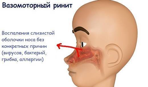 Лечение вазомоторного ринита народными средствами – самые эффективные