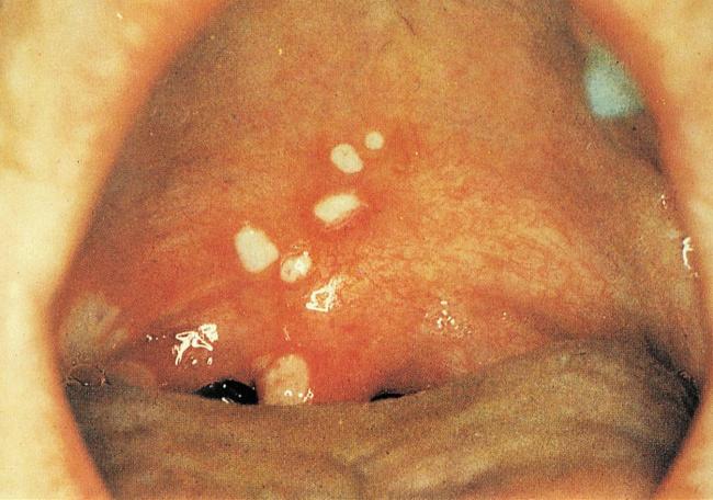 Streptococcus mitis: характеристика, патогенность, симптомы, лечение
