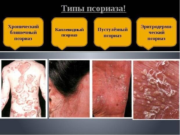 Мелкая сыпь по всему телу