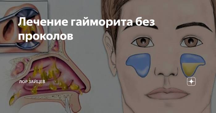 Гайморит: симптомы и лечение у взрослых