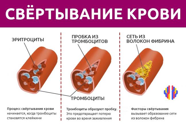 Выход клеток крови из костного мозга. синусоидальное дерево. неэффективность эритропоэза. неэффективный гранулопоэз.