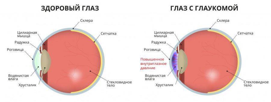 Глаукома: симптомы и лечение, что это такое - открытоугольная и закрытоугольная, признаки и острый приступ, профилактика, лечение