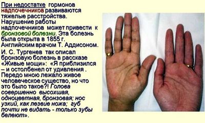 Болезнь аддисона. причины, симптомы, диагностика и лечение патологии :: polismed.com
