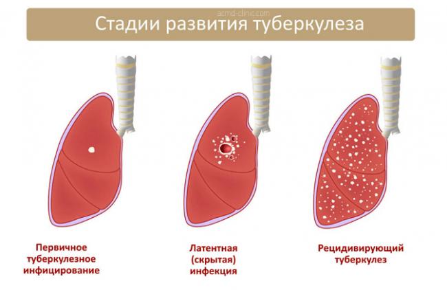 Очаговый туберкулез легких
