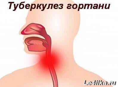 Туберкулез гортани