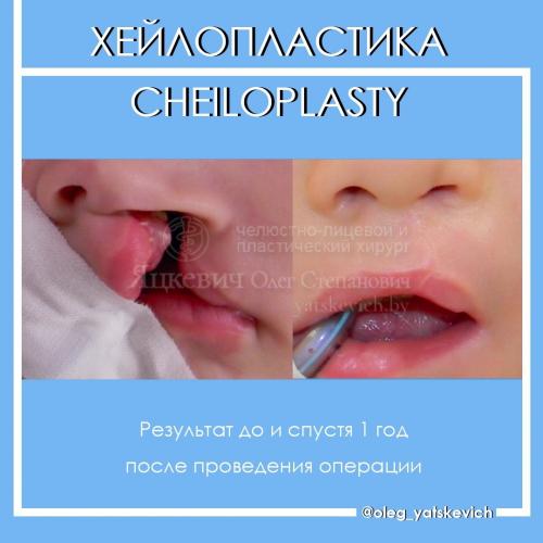 Заячья губа у человека причины. хейлосхизис (волчья пасть, заячья губа): что это, причины возникновения, симптомы, фото детей до и после операции