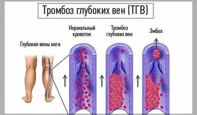 Болезнь туберкулез легких, фракция асд и другие методы лечения