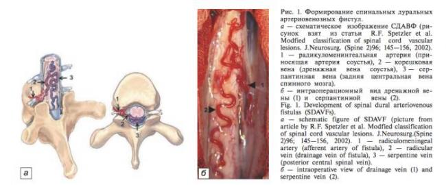 Артериовенозная фистула - dural arteriovenous fistula