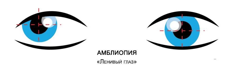 Что такое заболевание амблиопия у взрослых и как лечить приобретенный синдром ленивого глаза?