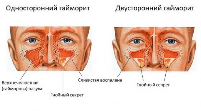 Гнойный гайморит: лечение, симптомы, последствия