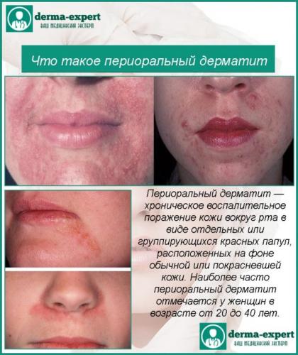 Симптомы и лечение гайморита, синусита и фронтита при беременности