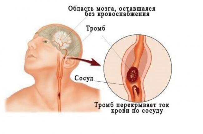 Болезни системы кровообращения