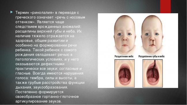 Причины и лечение волчьей пасти у детей