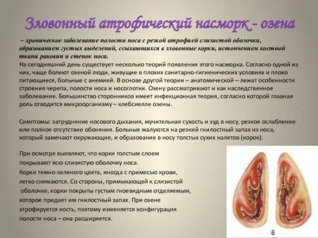 Озена: симптомы и лечение