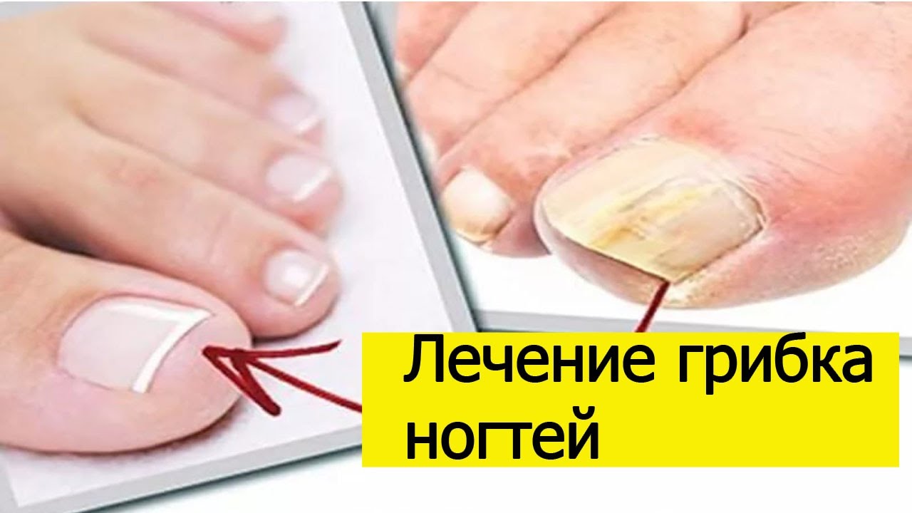 Паховая эпидермофития у мужчин - лечение в домашних условиях мазями и противогрибковыми средствами