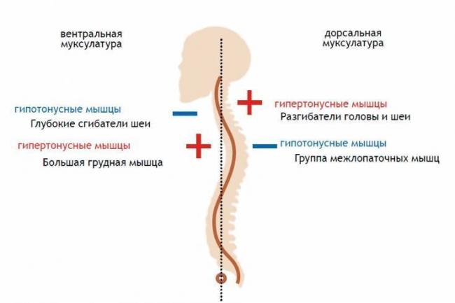 Как исправить опущенные плечи: советы и упражнения