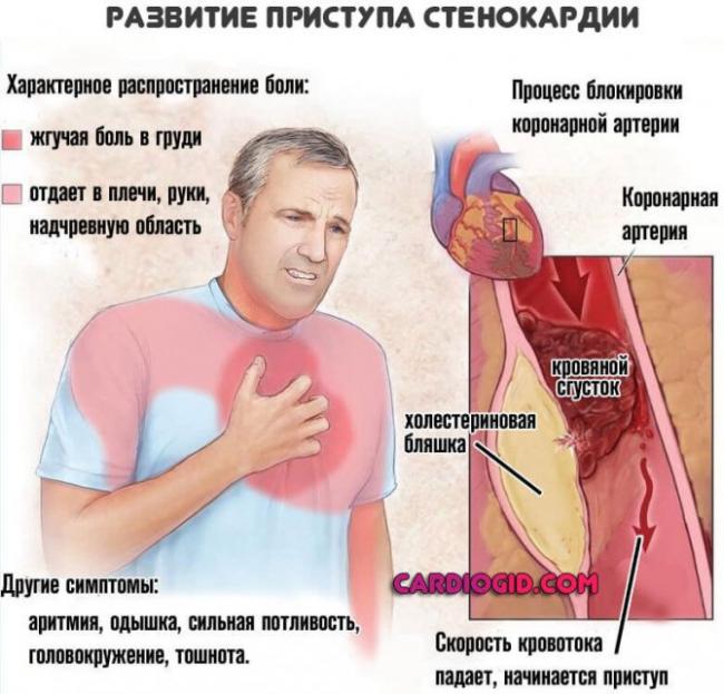 Кашель при сердечной недостаточности: симптомы и как его лечить