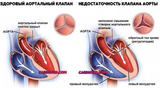 Кашель при сердечной недостаточности – особенности и лечение