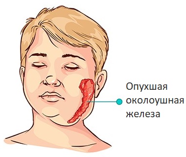 Свинка у детей (47 фото): симптомы паротита, первые признаки, лечение и профилактика болезни, эпидемический паротит на начальной стадии